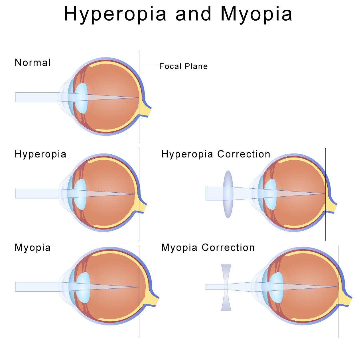 hypermetropia (farsightedness)