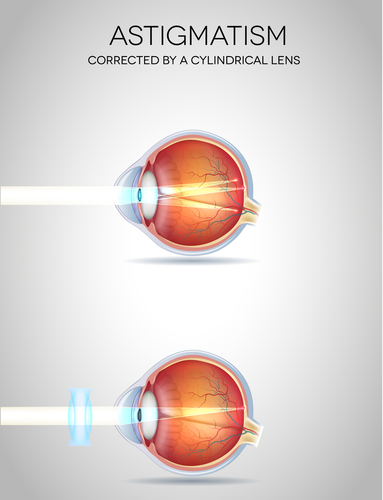 Astigmatism corrected with a toric lens