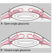Glaucoma Open and closed angle