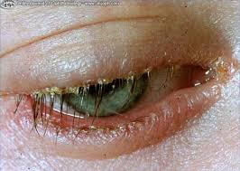 Blepharitis