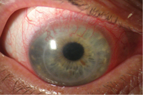 Corneal Neovascularisation